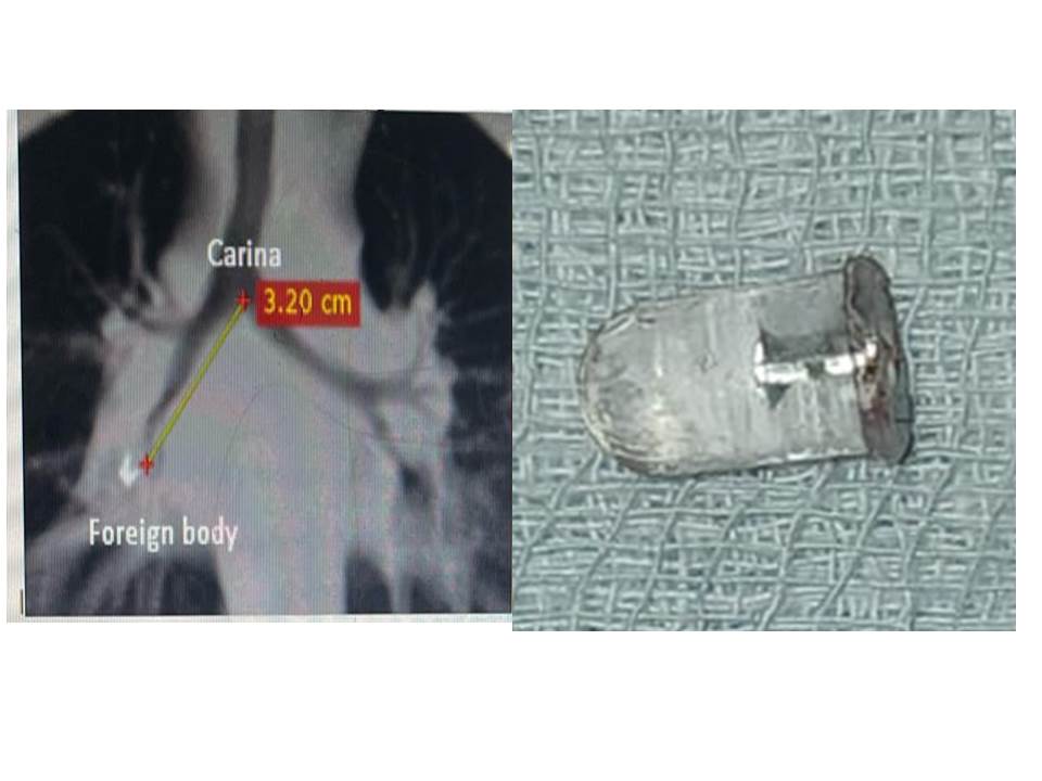 LED BULB REMOVED FROM KID’S LUNGS